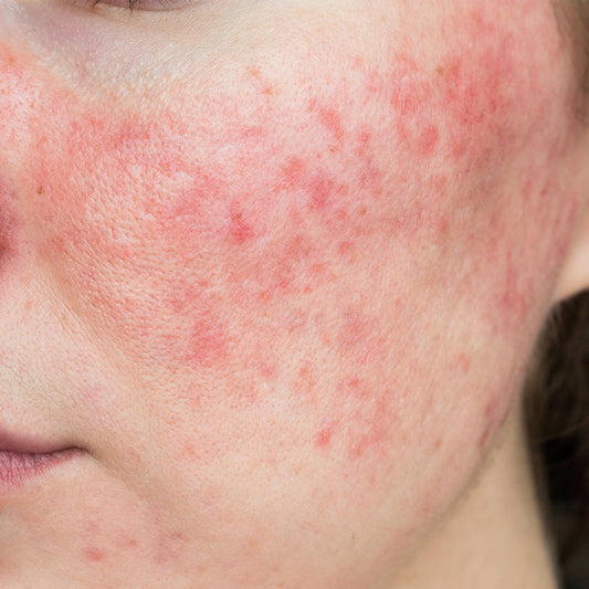 SENSITIVE SKIN: WHAT IS IT AND HOW DO YOU TAKE CARE OF IT?