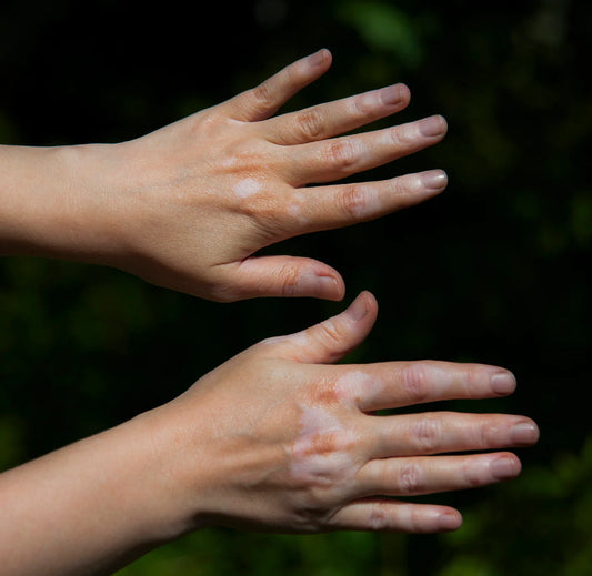 Understanding Hypopigmentation