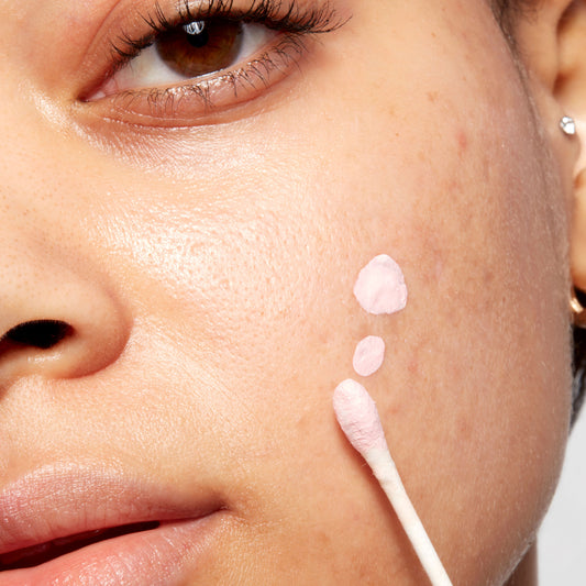 Conquering Acne, Part Four: How to Beat a Breakout