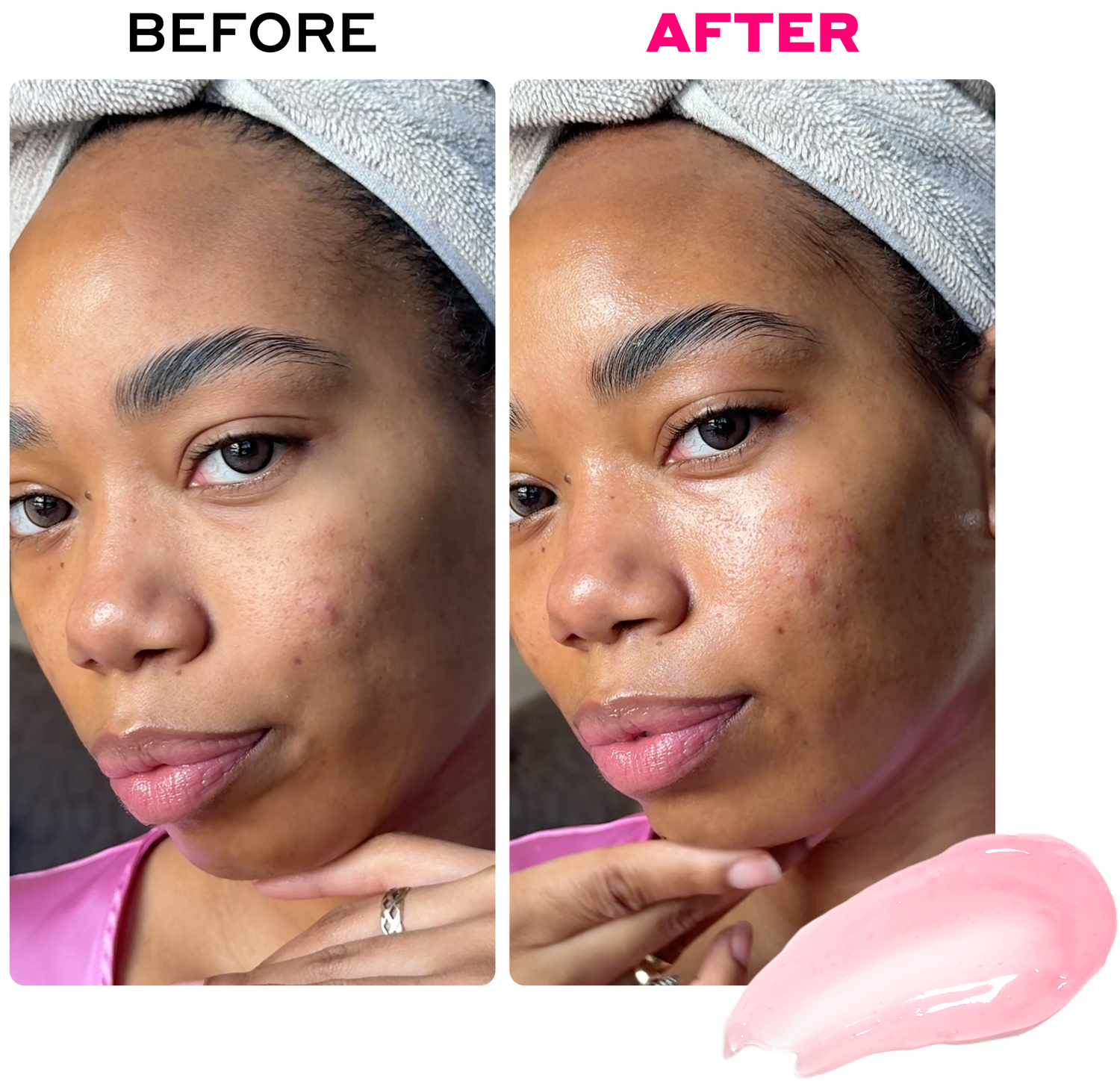 Before and after comparison of a woman's face with pink cream, showing skin improvement.
