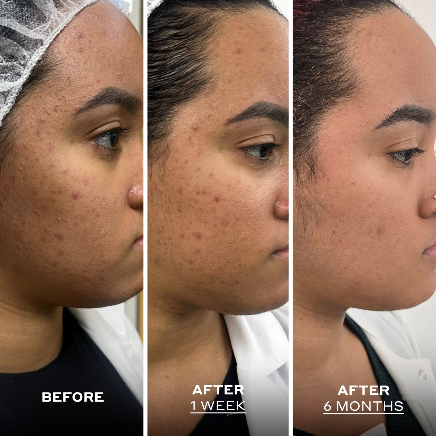 Skin Perfecting Balm with Salicylic Acid